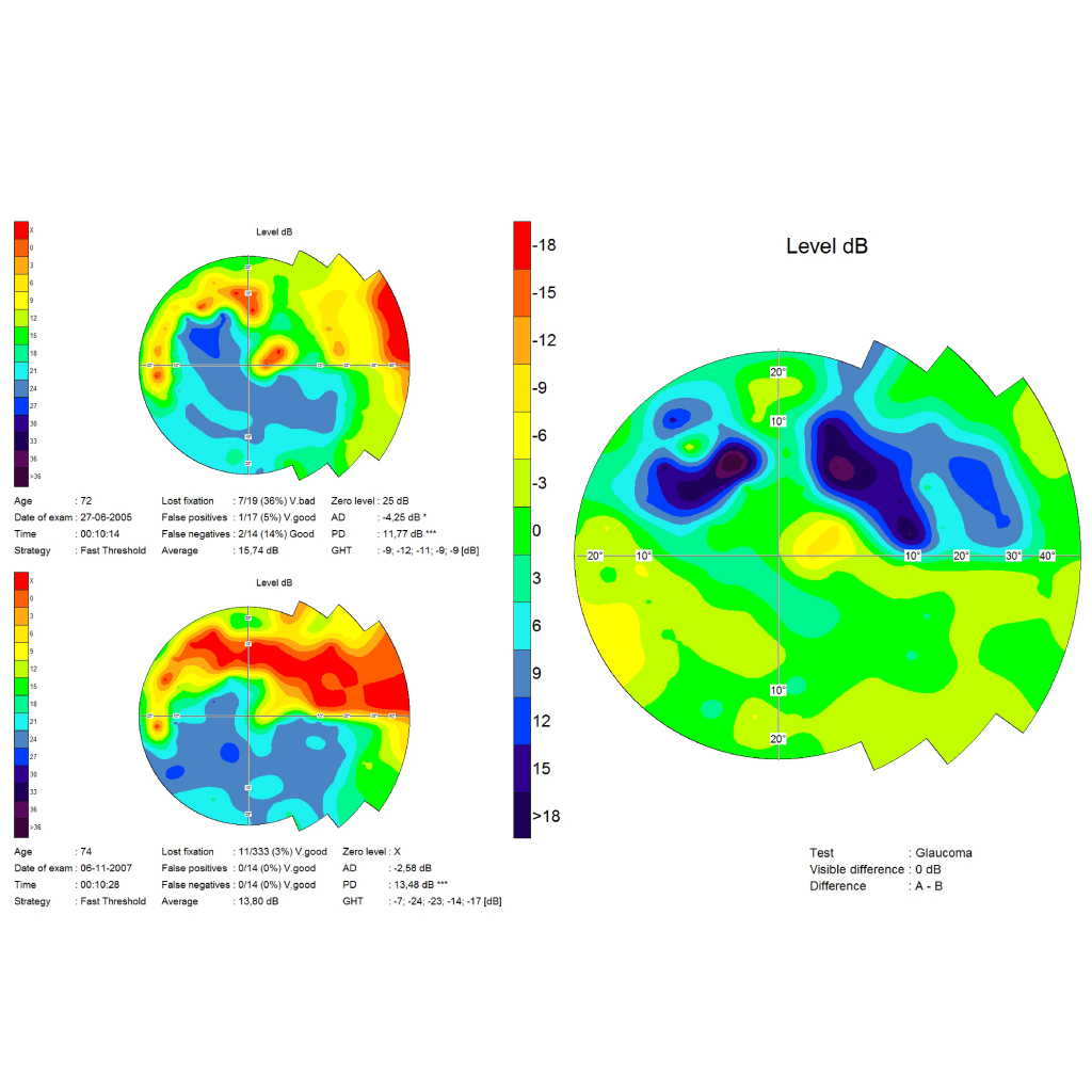 Frey Automated perimeters for eye diagnostics, visual field examination data comparison